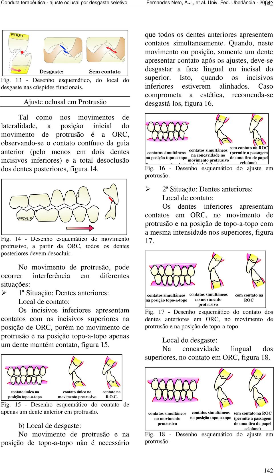 Ajuste oclusal em Protrusão Tal como nos moimentos de lateralidade, a posição inicial do moimento de protrusão é a ORC, obserando-se o contato contínuo da guia anterior (pelo menos em dois dentes