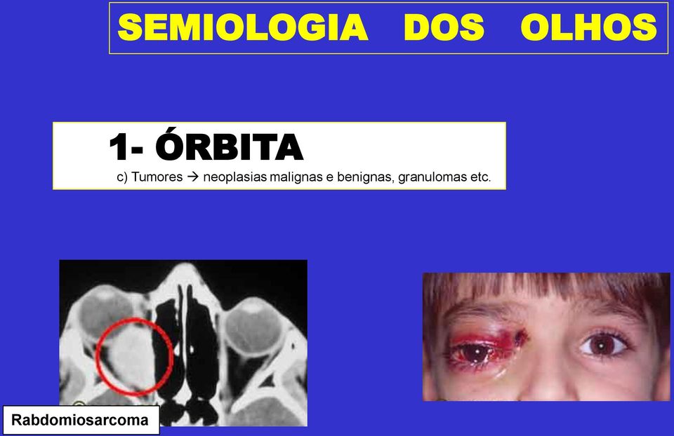 neoplasias malignas e