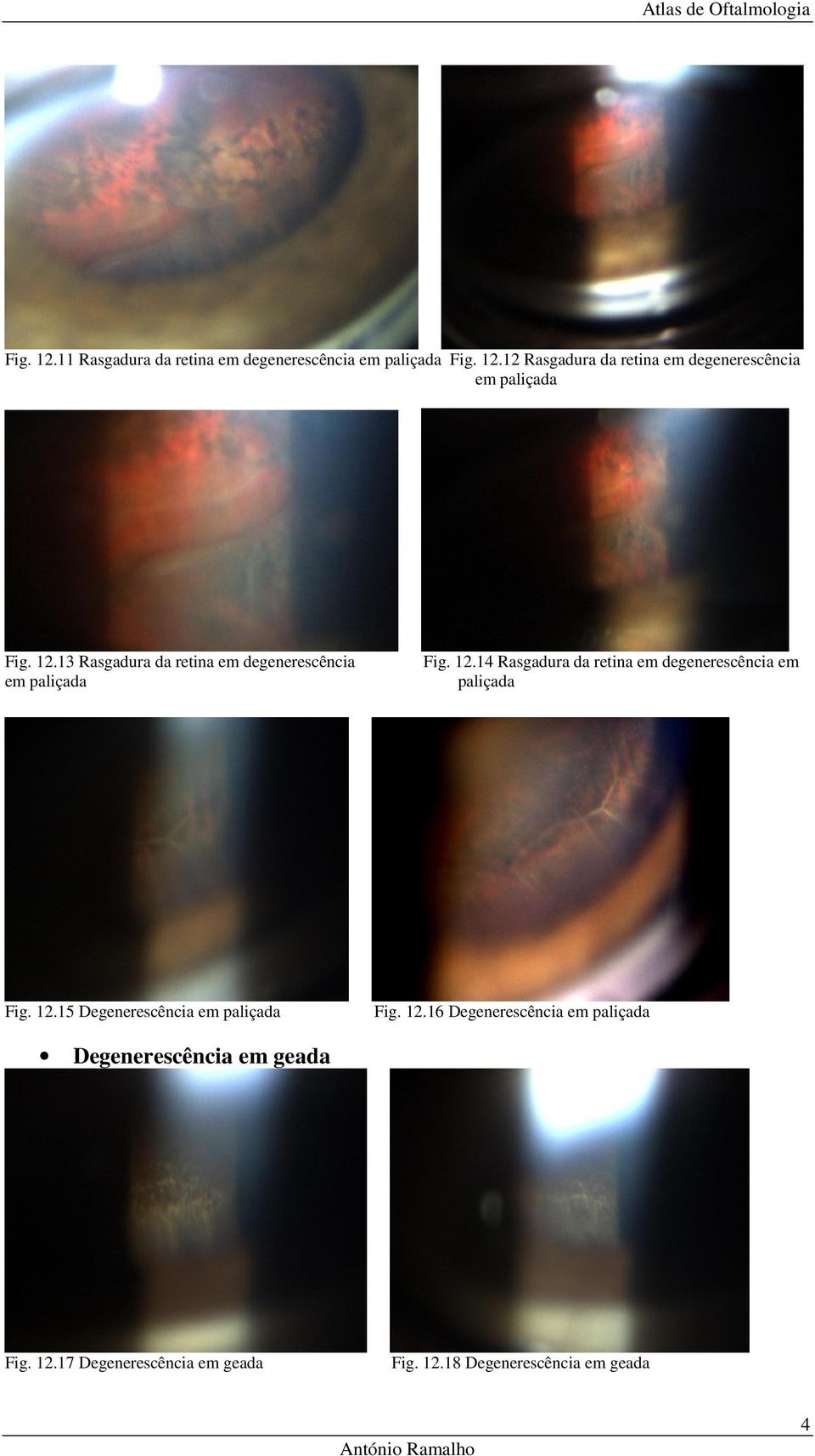 14 Rasgadura da retina em degenerescência em paliçada Fig. 12.