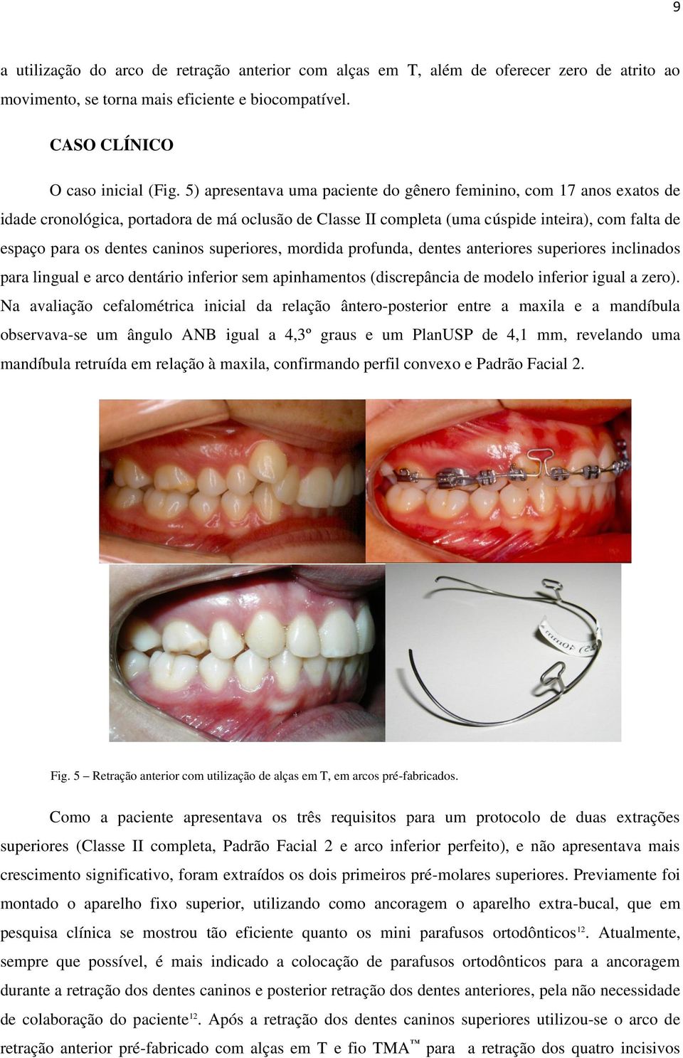 caninos superiores, mordida profunda, dentes anteriores superiores inclinados para lingual e arco dentário inferior sem apinhamentos (discrepância de modelo inferior igual a zero).