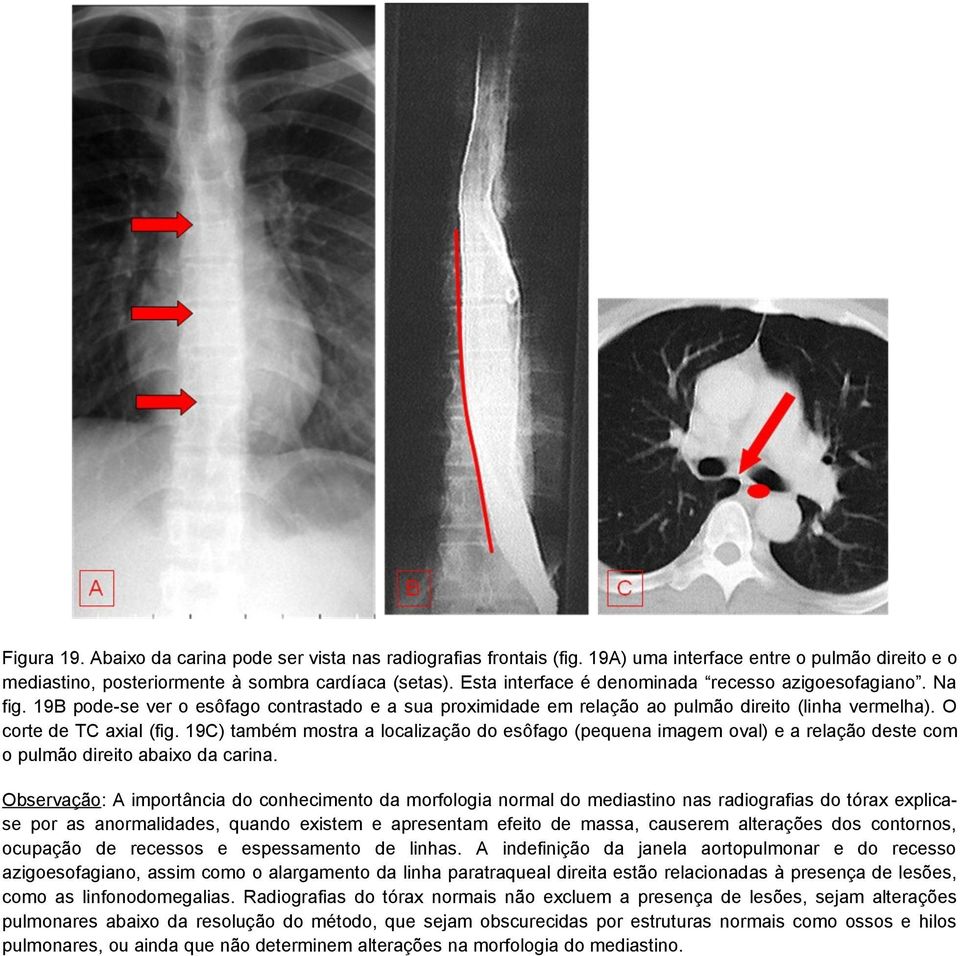 19C) também mostra a localização do esôfago (pequena imagem oval) e a relação deste com o pulmão direito abaixo da carina.