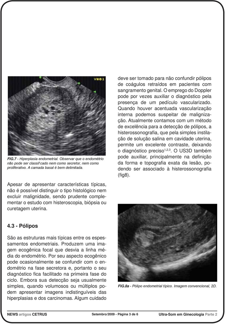 O emprego do Doppler pode por vezes auxiliar o diagnóstico pela presença de um pedículo vascularizado. Quando houver acentuada vascularização interna podemos suspeitar de malignização.