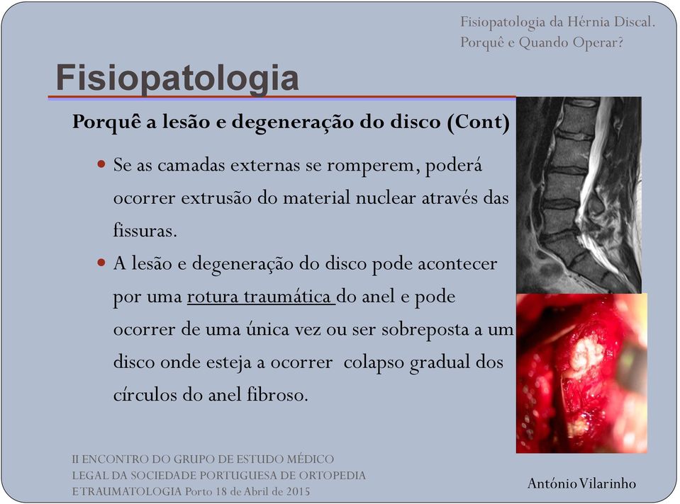 A lesão e degeneração do disco pode acontecer por uma rotura traumática do anel e pode ocorrer de uma única vez ou