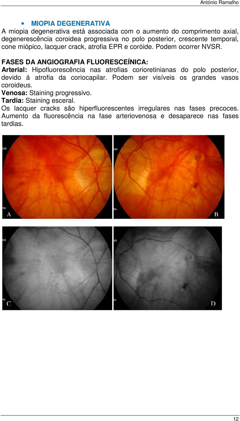 SS NGIOGRI LUORSÍNI: rterial: Hipofluorescência nas atrofias corioretinianas do polo posterior, devido á atrofia da coriocapilar.