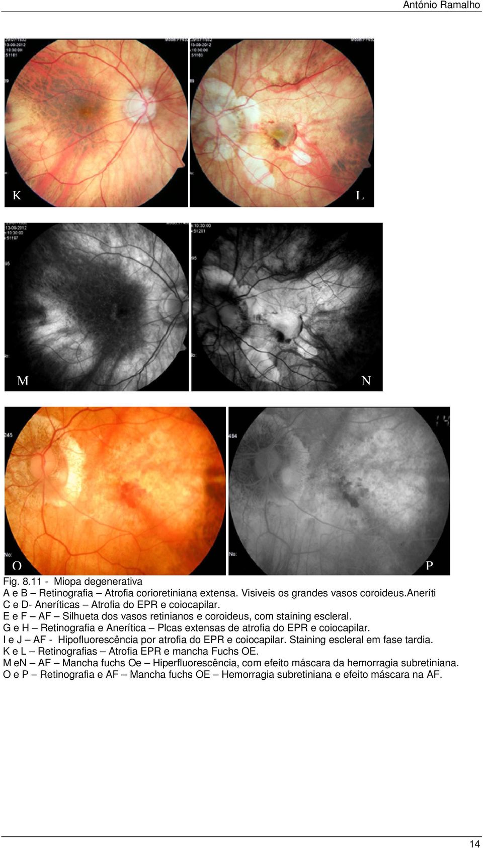 G e H Retinografia e nerítica Plcas extensas de atrofia do PR e coiocapilar. I e J - Hipofluorescência por atrofia do PR e coiocapilar.