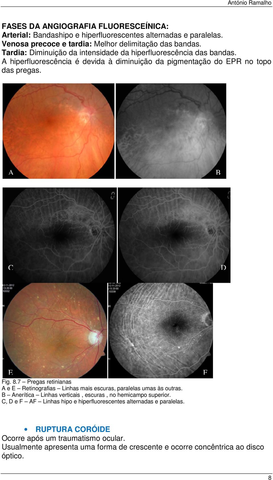 7 Pregas retinianas e Retinografias Linhas mais escuras, paralelas umas às outras. nerítica Linhas verticais, escuras, no hemicampo superior.