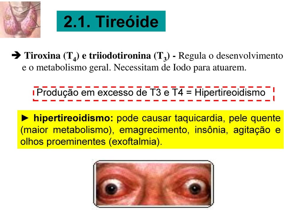 Produção em excesso de T3 e T4 = Hipertireoidismo hipertireoidismo: pode causar