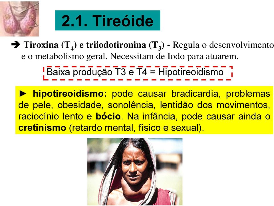 Baixa produção T3 e T4 = Hipotireoidismo hipotireoidismo: pode causar bradicardia, problemas de