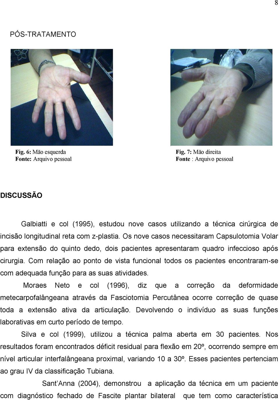 Os nove casos necessitaram Capsulotomia Volar para extensão do quinto dedo, dois pacientes apresentaram quadro infeccioso após cirurgia.