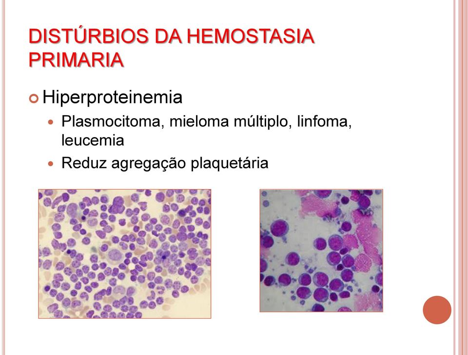 Plasmocitoma, mieloma múltiplo,