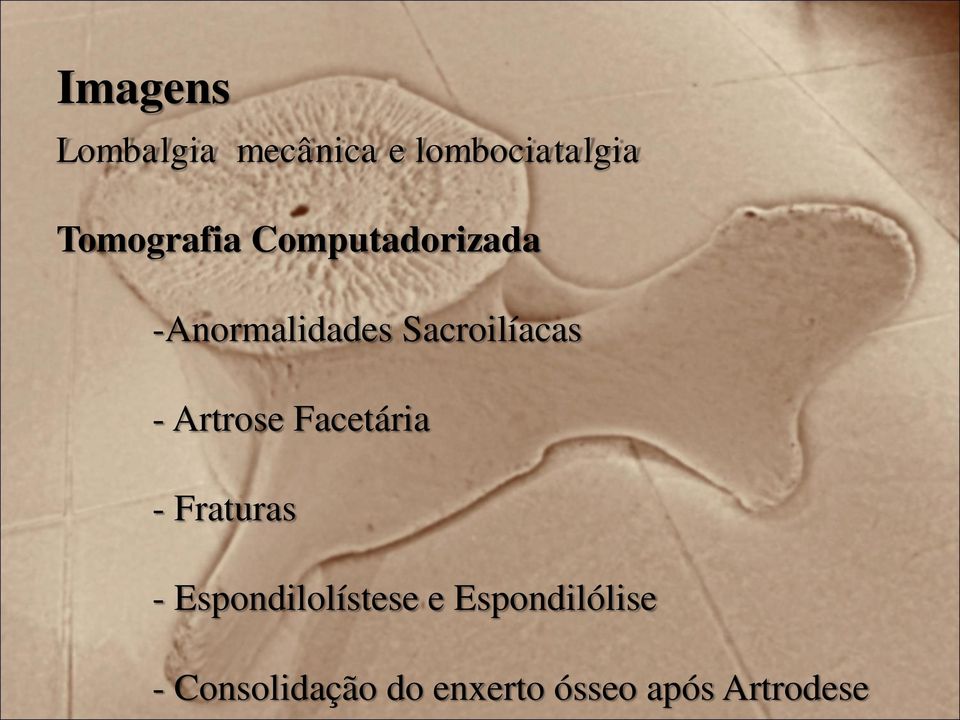 Sacroilíacas - Artrose Facetária - Fraturas -