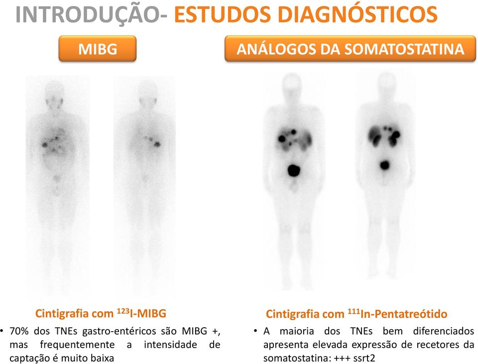 de captação é muito baixa Cintigrafia com 111 In-Pentatreótido A maioria dos TNEs