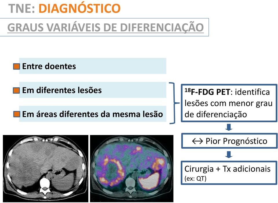 lesão 18 F-FDG PET: identifica lesões com menor grau de