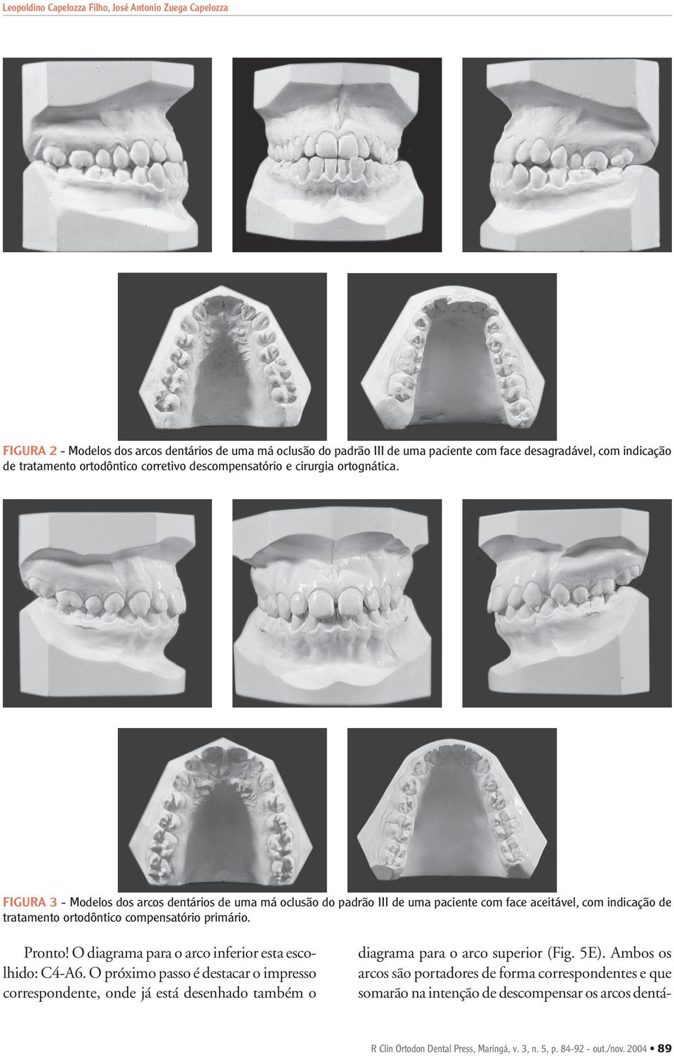 FIGURA 3 - Modelos dos arcos dentários de uma má oclusão do padrão III de uma paciente com face aceitável, com indicação de tratamento ortodôntico compensatório primário. Pronto!