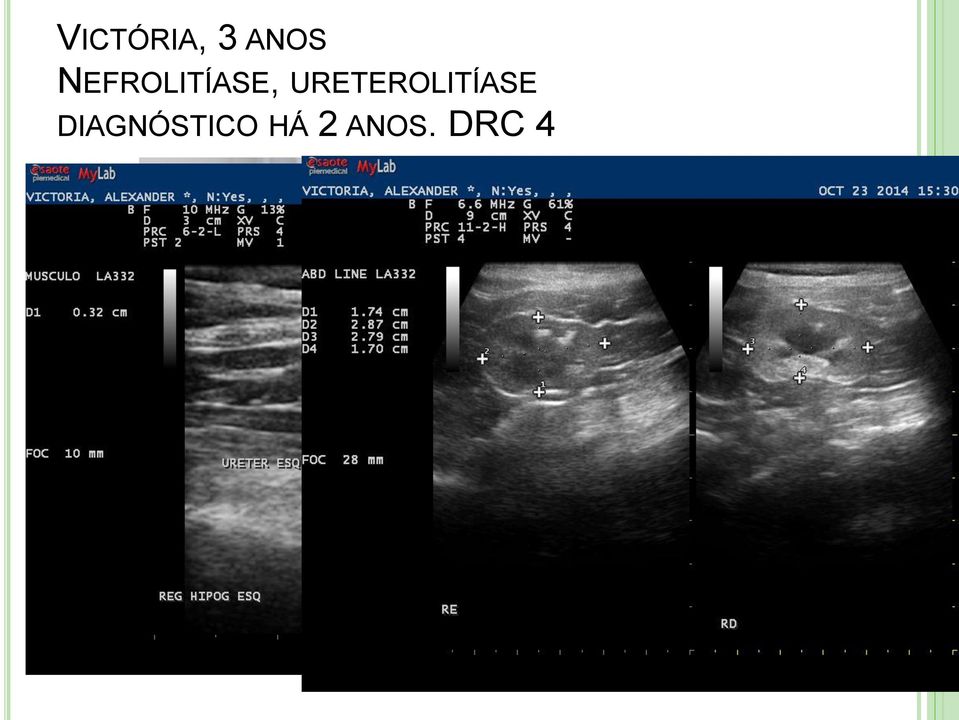 URETEROLITÍASE