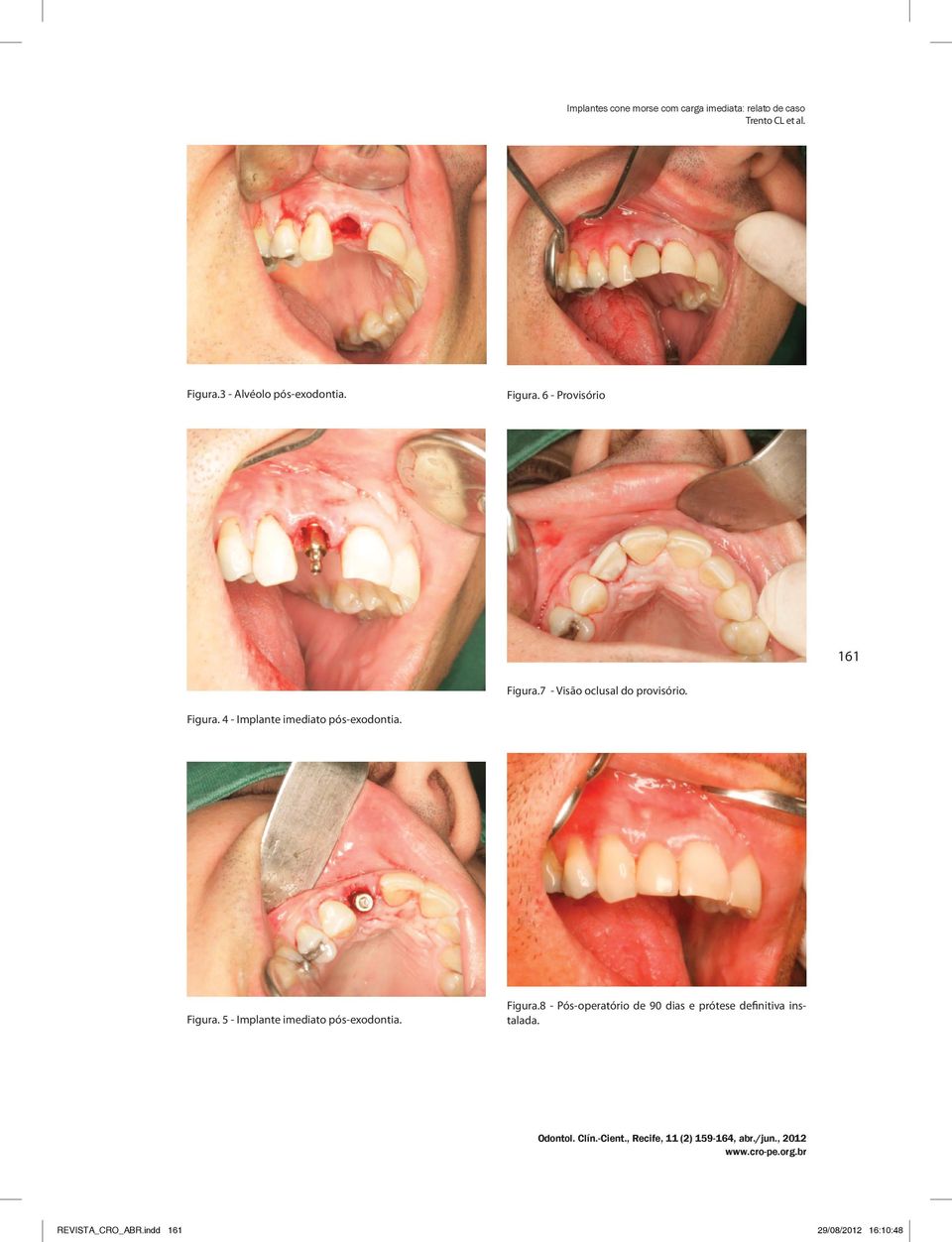 4 - Implante imediato pós-exodontia. Figura.