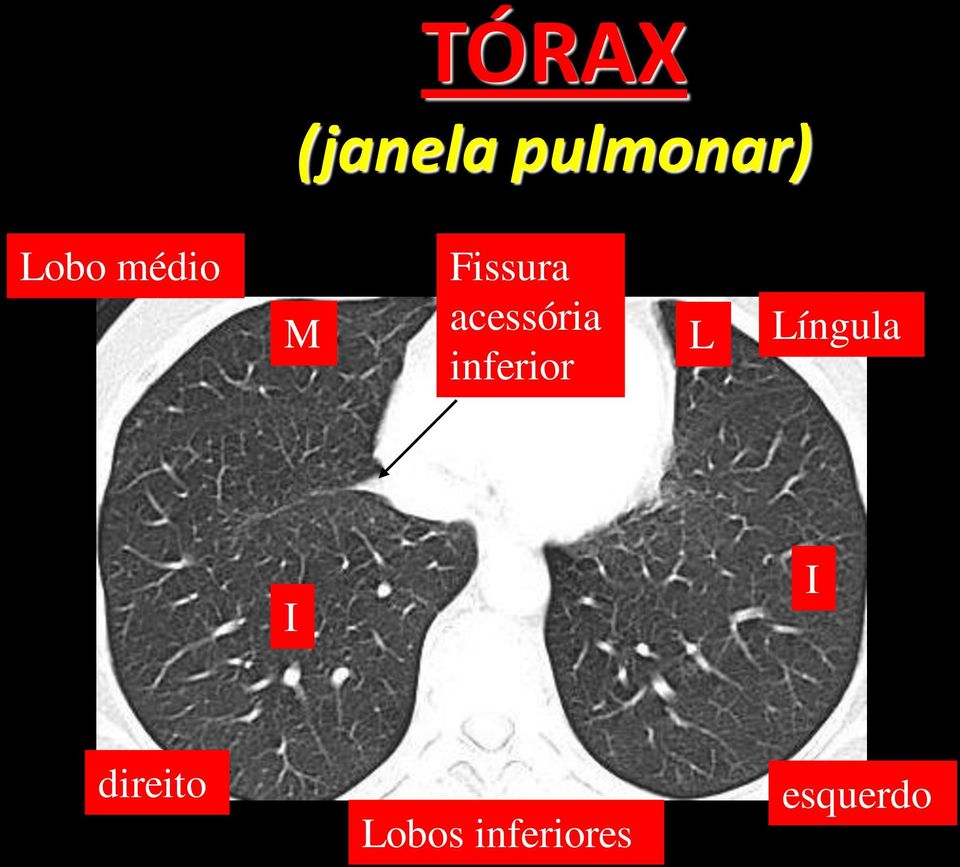 inferior L Língula I I