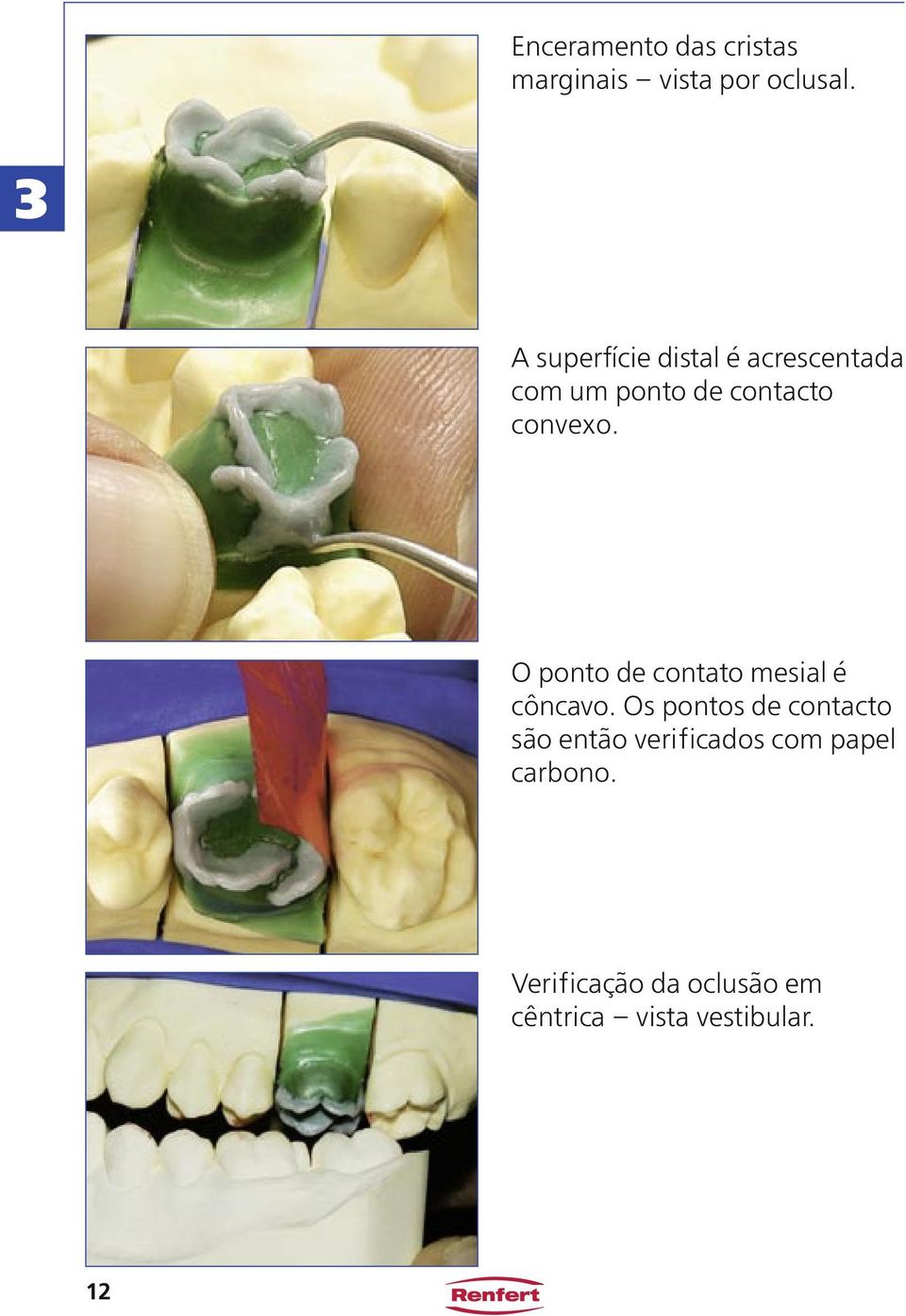 O ponto de contato mesial é côncavo.