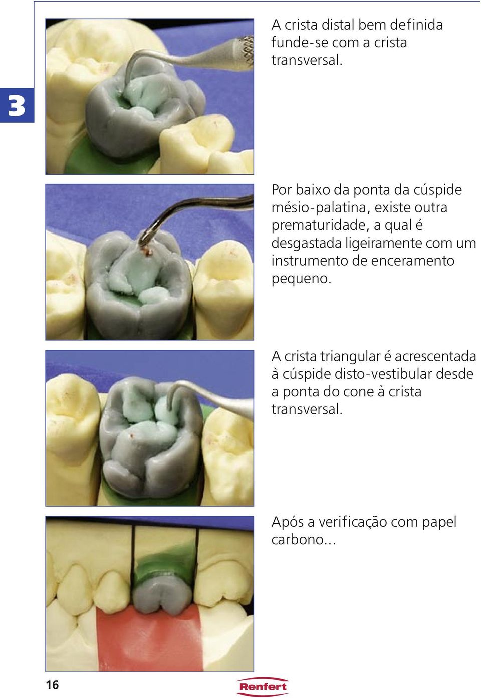 desgastada ligeiramente com um instrumento de enceramento pequeno.