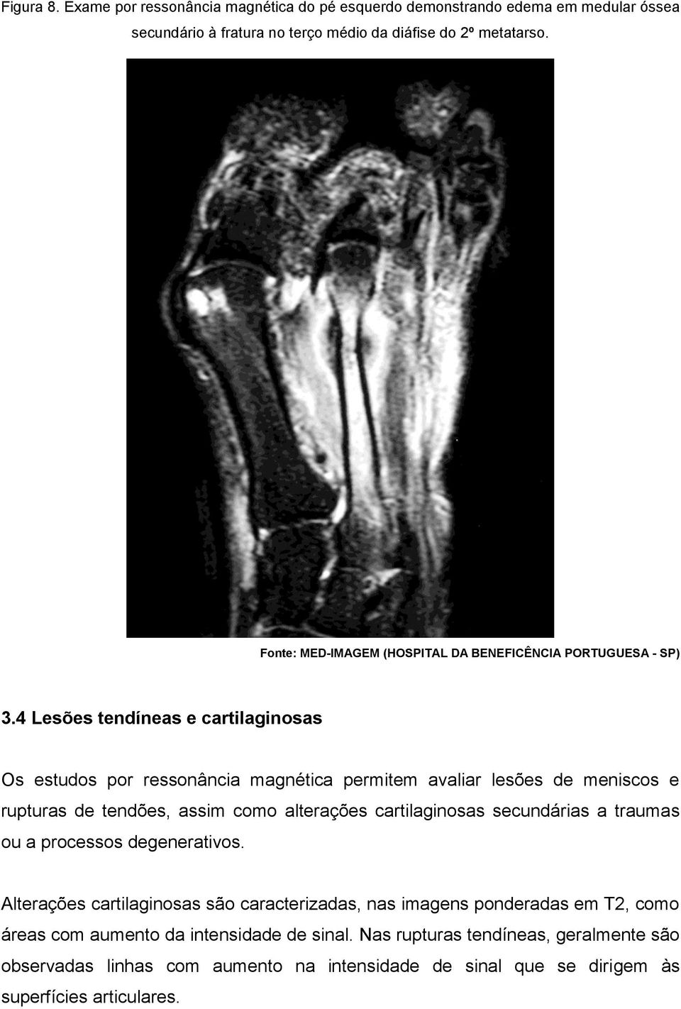 4 Lesões tendíneas e cartilaginosas Os estudos por ressonância magnética permitem avaliar lesões de meniscos e rupturas de tendões, assim como alterações cartilaginosas