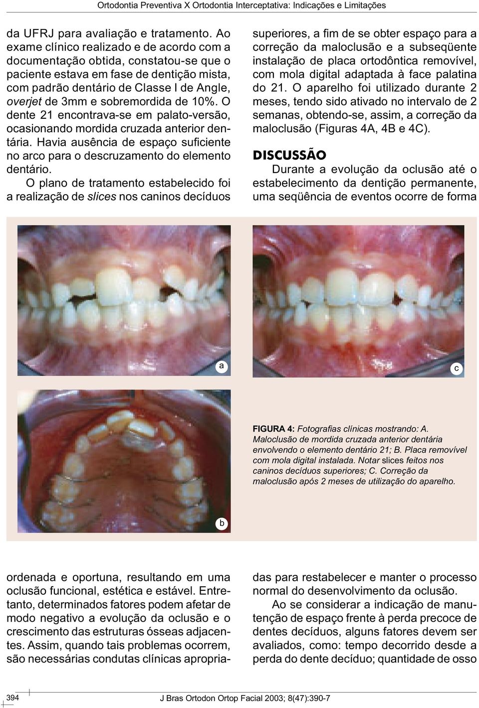 de 10%. O dente 21 encontrava-se em palato-versão, ocasionando mordida cruzada anterior dentária. Havia ausência de espaço sufi ciente no arco para o descruzamento do elemento dentário.