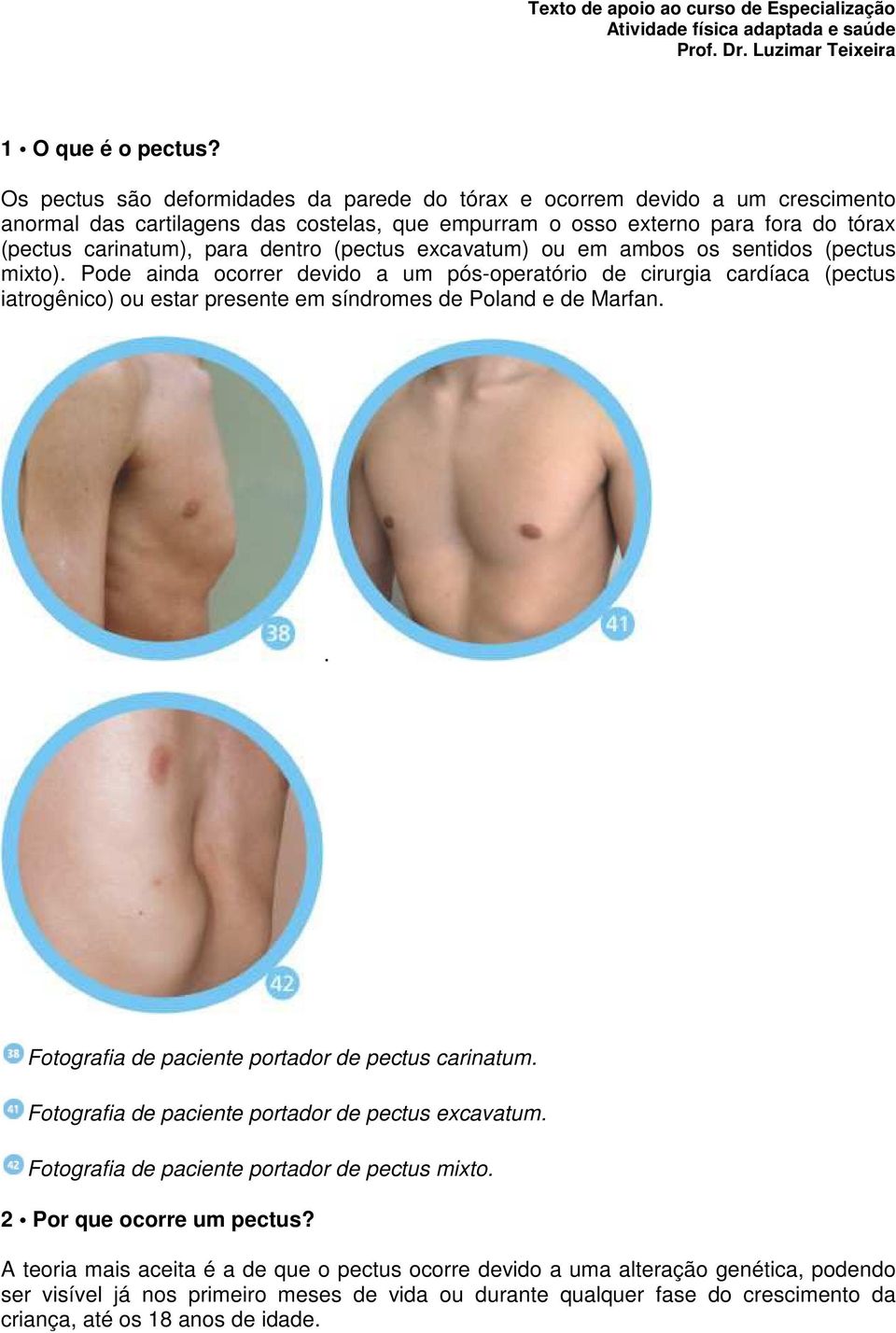 (pectus excavatum) ou em ambos os sentidos (pectus mixto). Pode ainda ocorrer devido a um pós-operatório de cirurgia cardíaca (pectus iatrogênico) ou estar presente em síndromes de Poland e de Marfan.