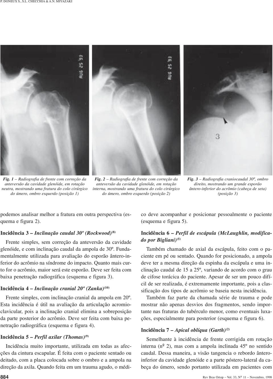 2 Radiografia de frente com correção da anteversão da cavidade glenóide, em rotação interna, mostrando uma fratura do colo cirúrgico do úmero, ombro esquerdo (posição 2) Fig.