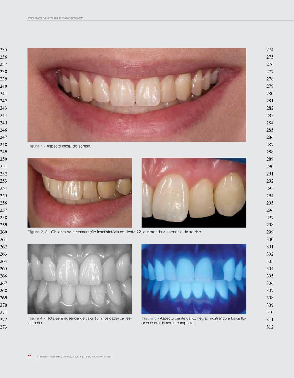 Aspecto inicial do sorriso. Figura 2, 3 - Observa-se a restauração insatisfatória no dente 22, quebrando a harmonia do sorriso.