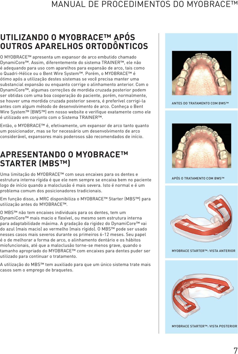 Porém, o MYOBRACE é ótimo após a utilização destes sistemas se você precisa manter uma substancial expansão ou enquanto corrige o alinhamento anterior.