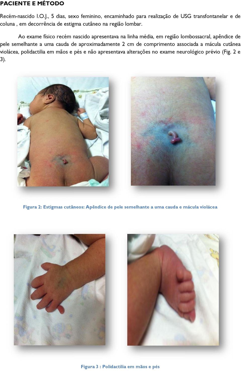 Ao exame físico recém nascido apresentava na linha média, em região lombossacral, apêndice de pele semelhante a uma cauda de aproximadamente 2 cm de