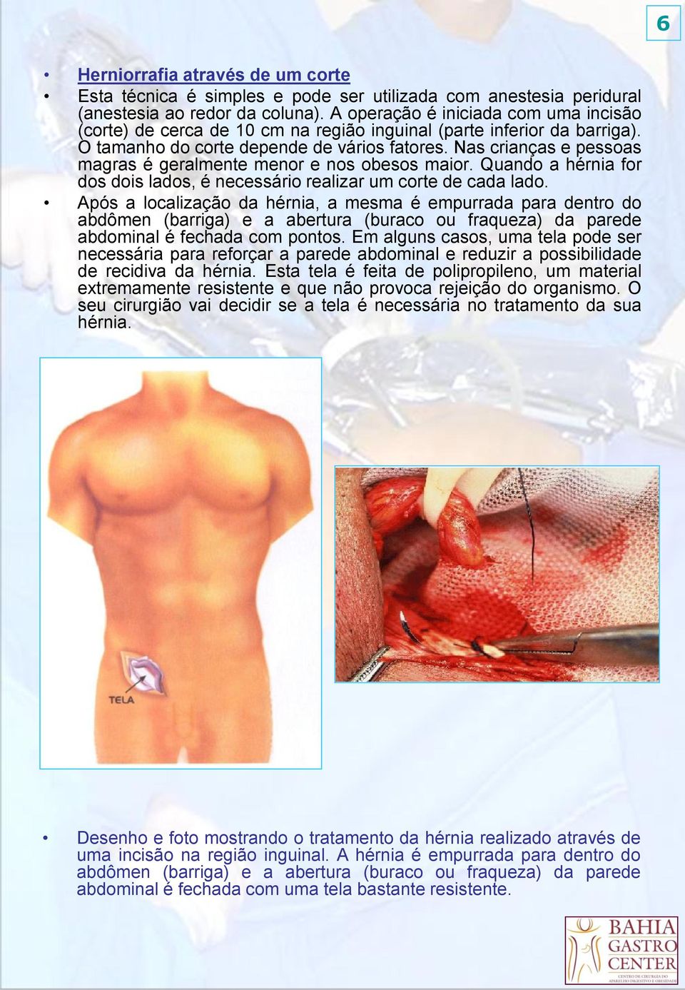 Nas crianças e pessoas magras é geralmente menor e nos obesos maior. Quando a hérnia for dos dois lados, é necessário realizar um corte de cada lado.