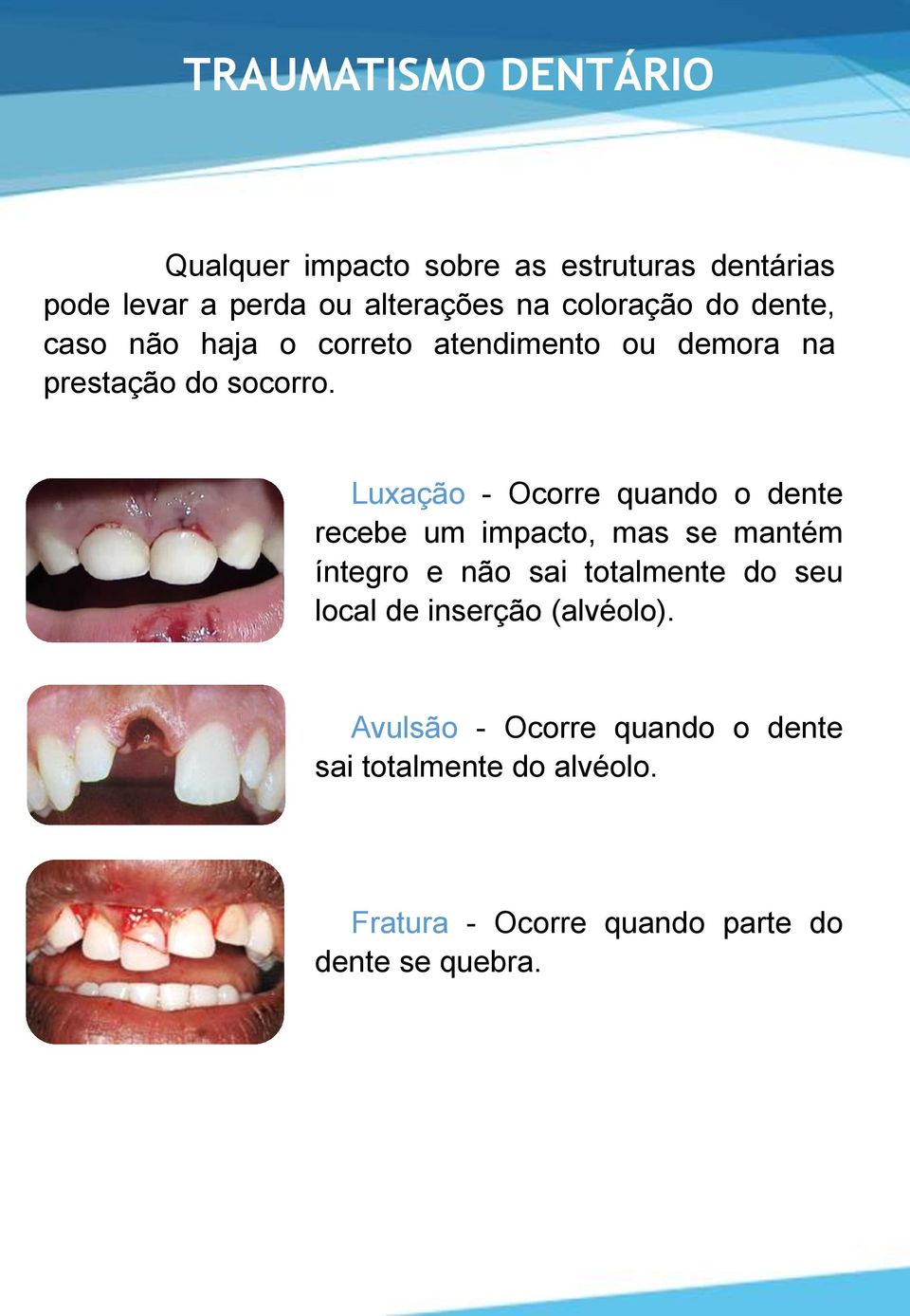 Luxação - Ocorre quando o dente recebe um impacto, mas se mantém íntegro e não sai totalmente do seu local