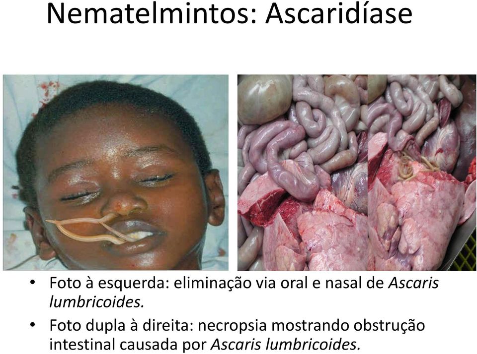 lumbricoides.