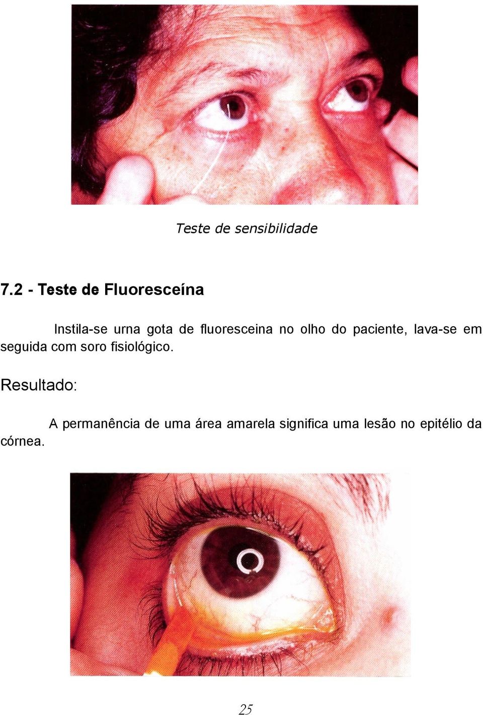 fluoresceina no olho do paciente, lava-se em seguida com