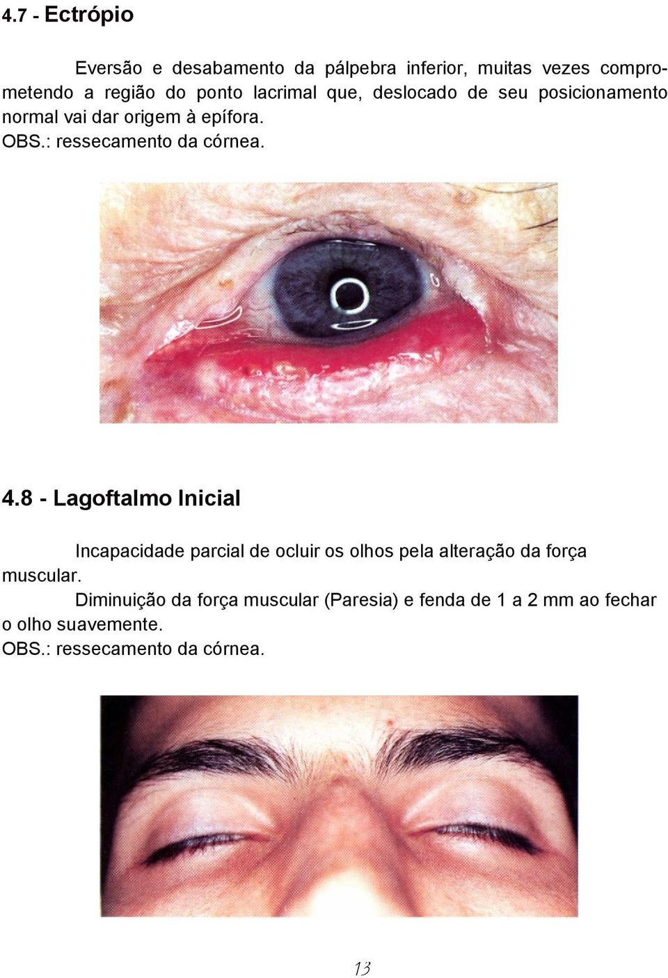 4.8 - Lagoftalmo Inicial Incapacidade parcial de ocluir os olhos pela alteração da força muscular.