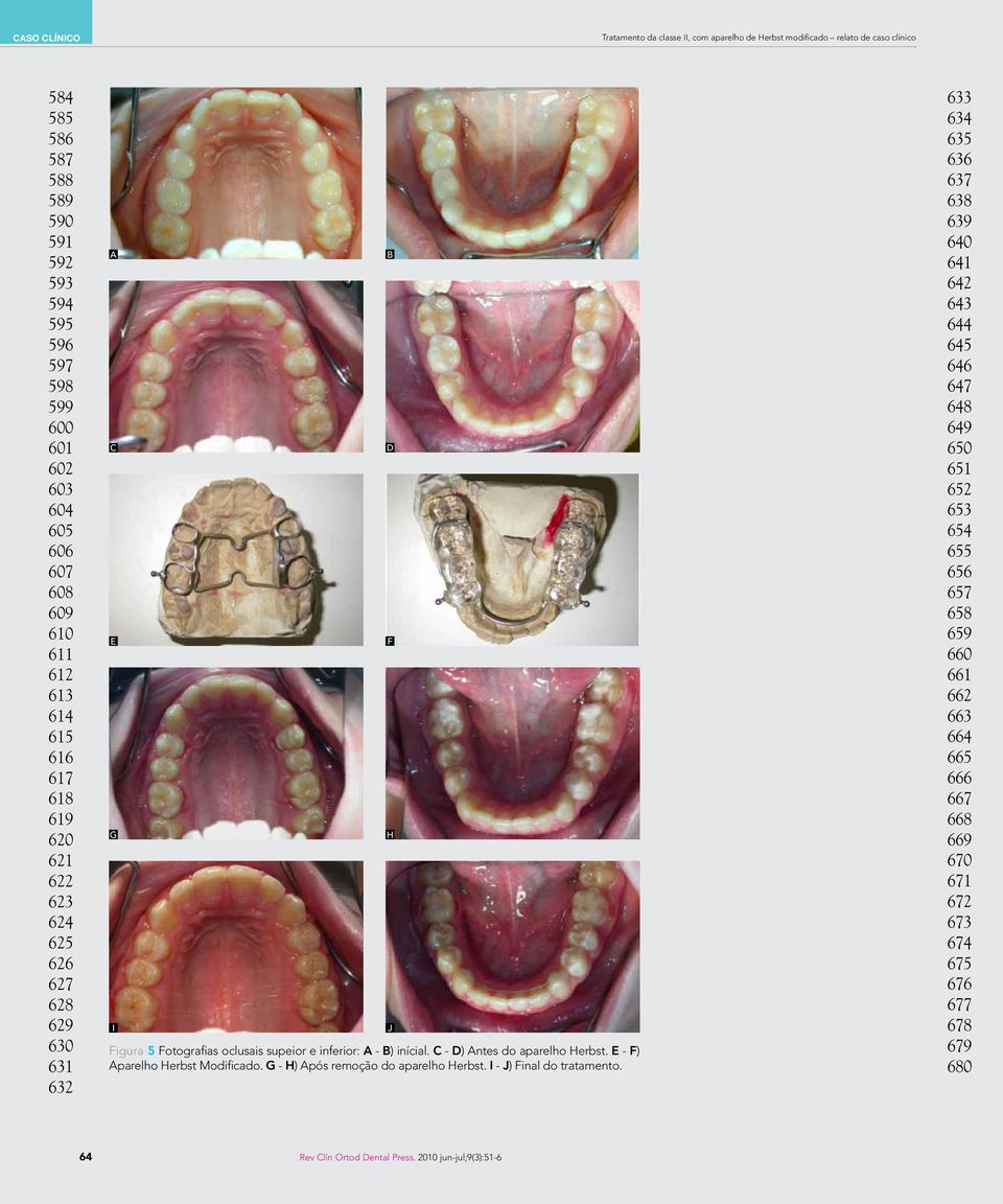 C - D) Antes do aparelho Herbst. E - F) Aparelho Herbst Modificado. G - H) Após remoção do aparelho Herbst. I - J) Final do tratamento.