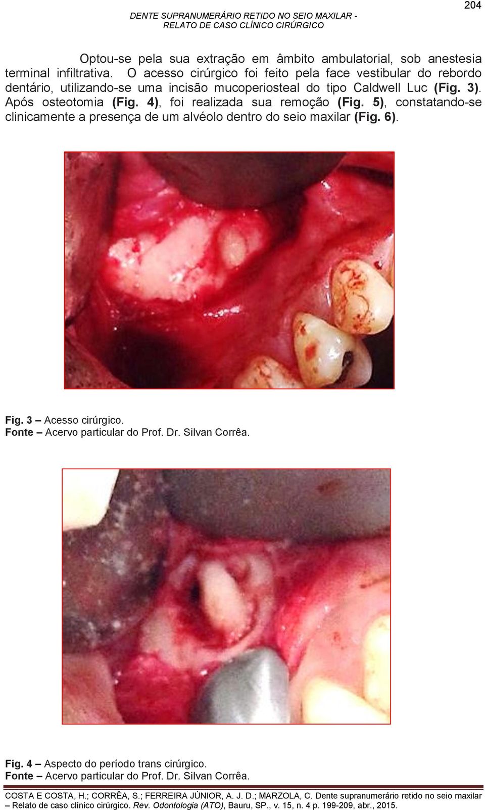 do tipo Caldwell Luc (Fig. 3). Após osteotomia (Fig. 4), foi realizada sua remoção (Fig.