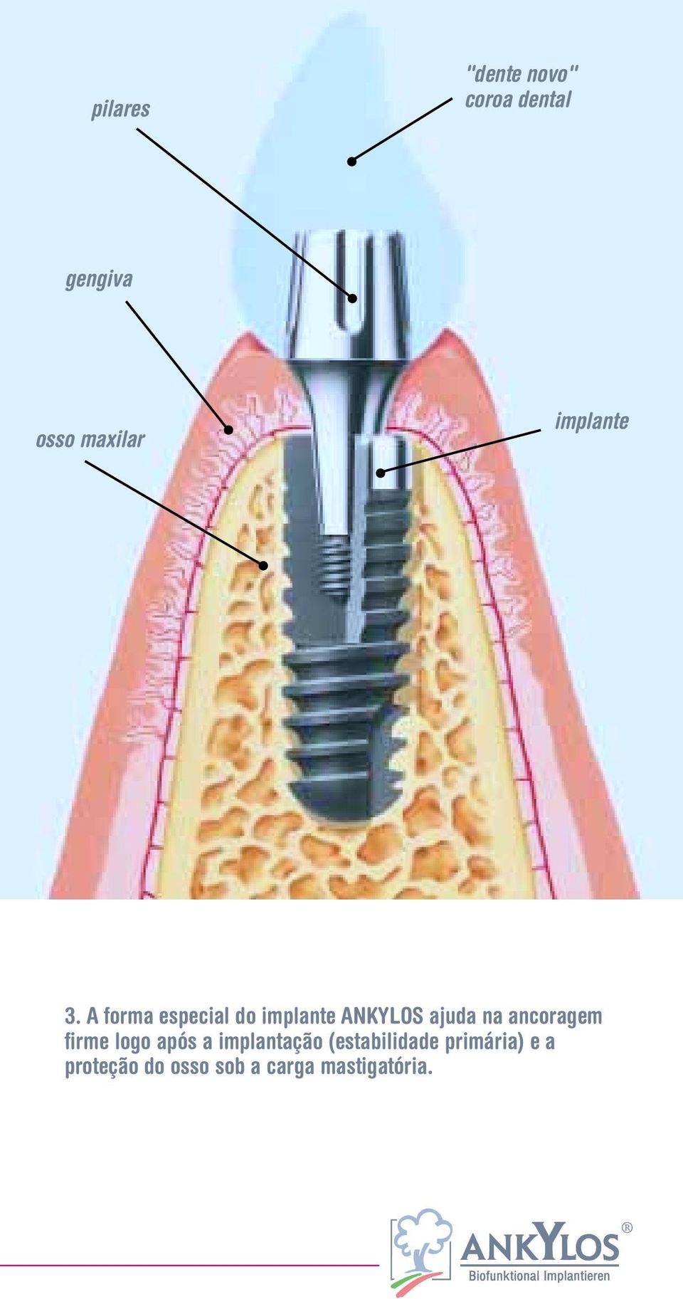 A forma especial do implante ANKYLOS ajuda na ancoragem