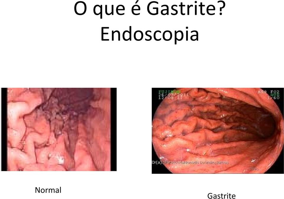 Endoscopia