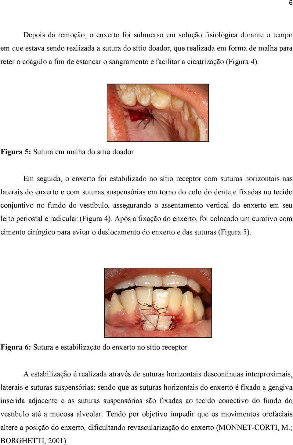 Figura 5: Sutura em malha do sítio doador Em seguida, o enxerto foi estabilizado no sítio receptor com suturas horizontais nas laterais do enxerto e com suturas suspensórias em torno do colo do dente