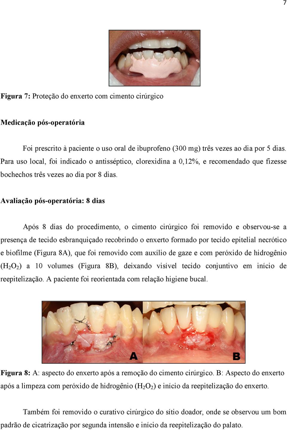 Avaliação pós-operatória: 8 dias Após 8 dias do procedimento, o cimento cirúrgico foi removido e observou-se a presença de tecido esbranquiçado recobrindo o enxerto formado por tecido epitelial