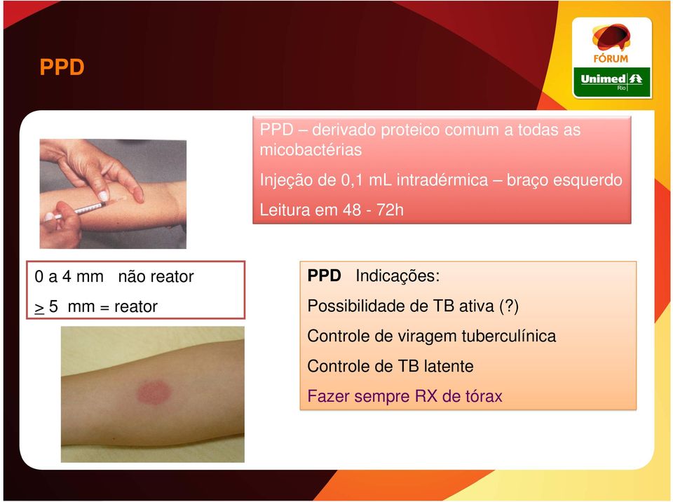 reator > 5 mm = reator PPD Indicações: Possibilidade de TB ativa (?