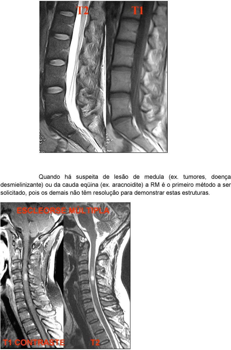 aracnoidite) a RM é o primeiro método a ser solicitado,
