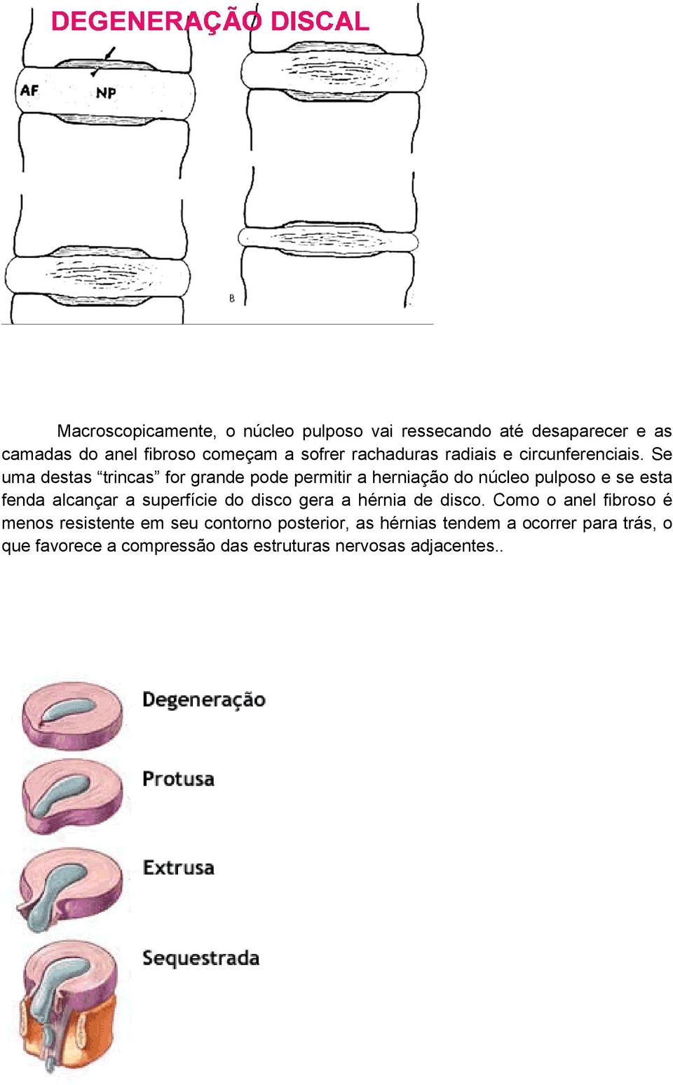 Se uma destas trincas for grande pode permitir a herniação do núcleo pulposo e se esta fenda alcançar a superfície do