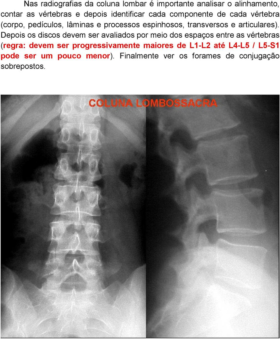 Depois os discos devem ser avaliados por meio dos espaços entre as vértebras (regra: devem ser progressivamente