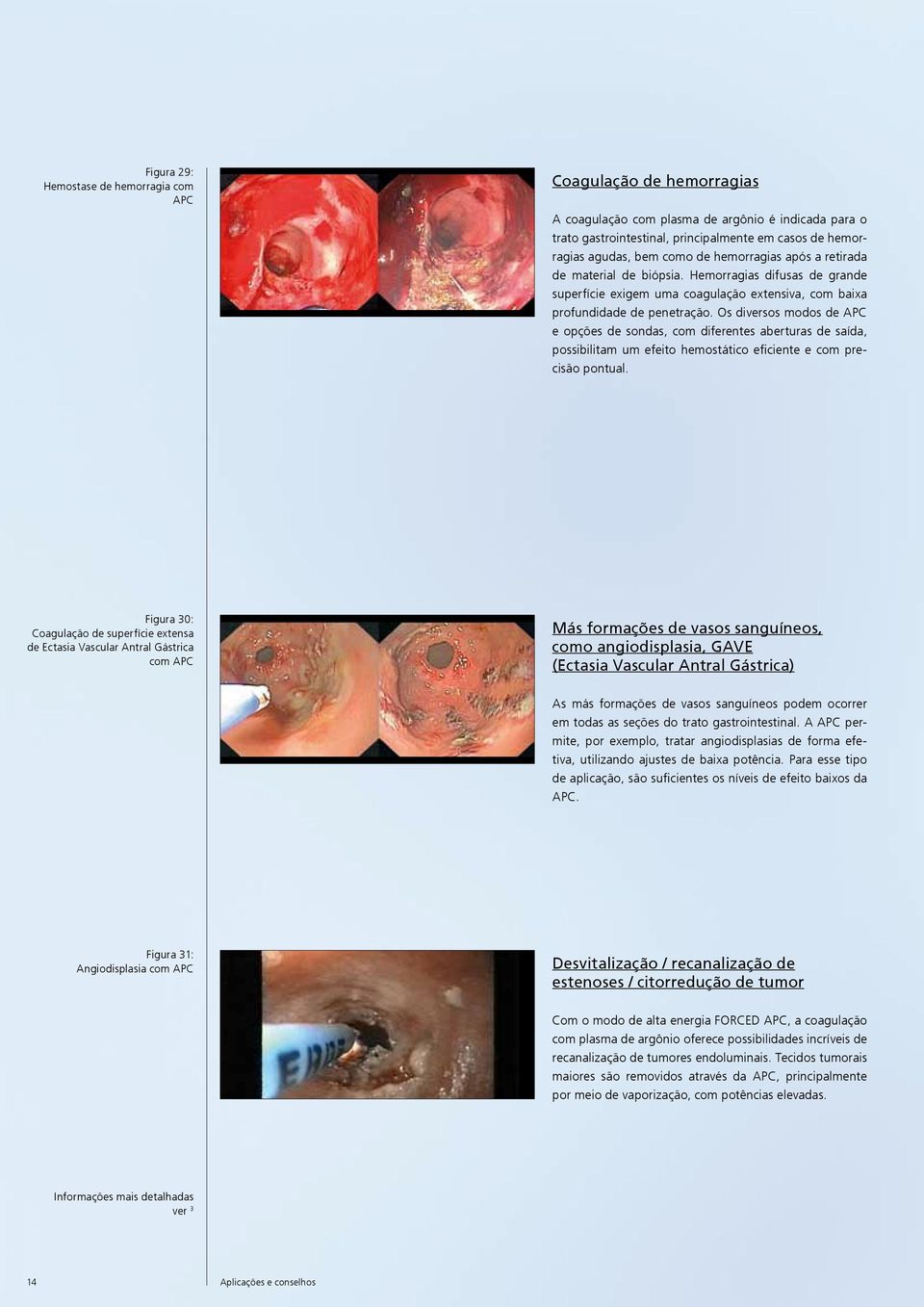 Os diversos modos de APC e opções de sondas, com diferentes aberturas de saída, possibilitam um efeito hemostático eficiente e com precisão pontual.