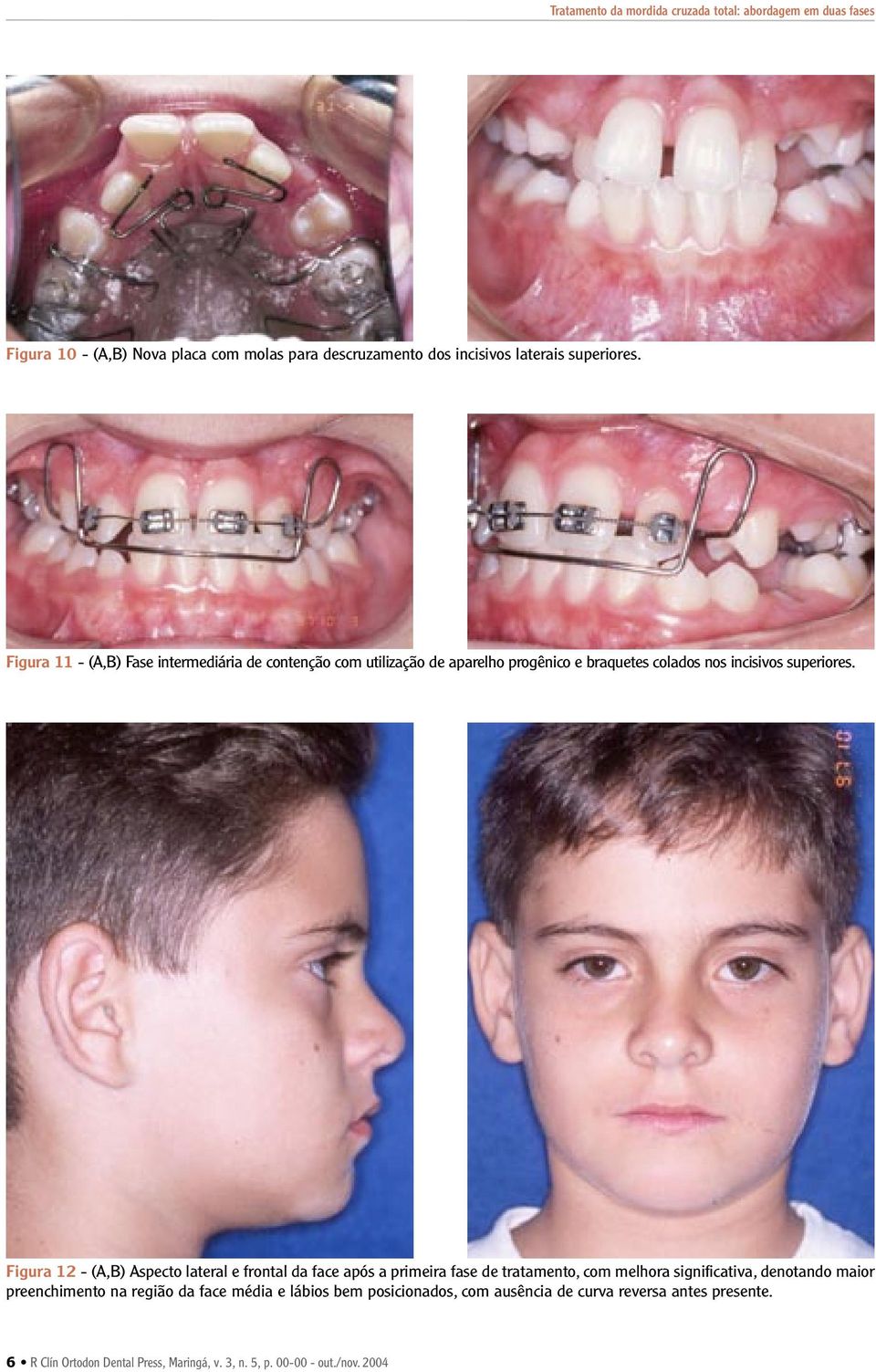 Figura 12 - (A,B) Aspecto lateral e frontal da face após a primeira fase de tratamento, com melhora significativa, denotando maior preenchimento na