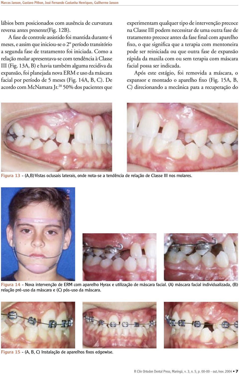 Como a relação molar apresentava-se com tendência à Classe III (Fig. 13A, B) e havia também alguma recidiva da expansão, foi planejada nova ERM e uso da máscara facial por período de 5 meses (Fig.