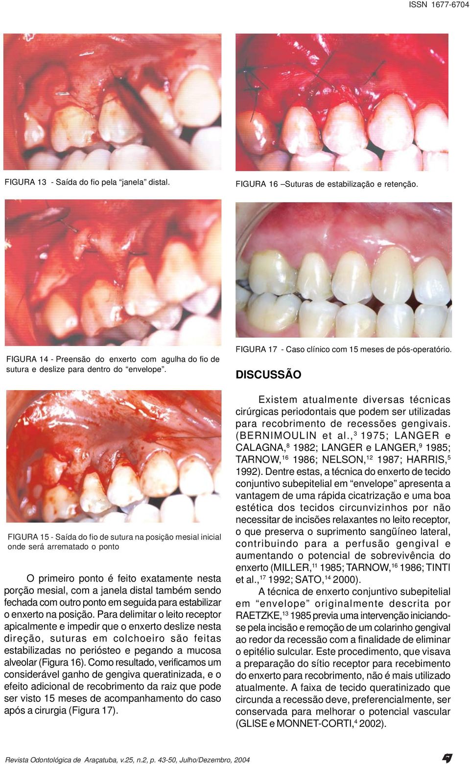 ponto em seguida para estabilizar o enxerto na posição.