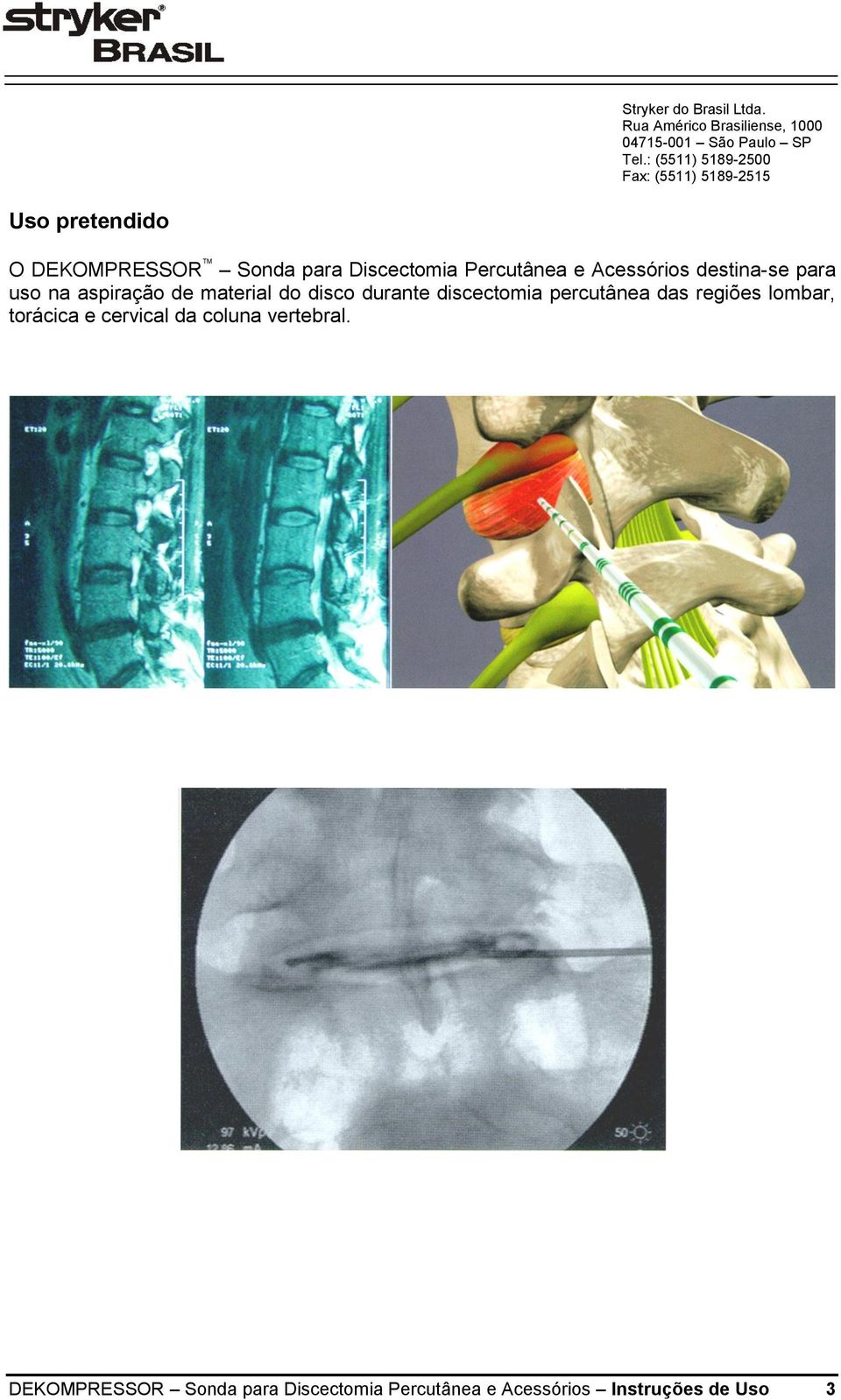 discectomia percutânea das regiões lombar, torácica e cervical da coluna